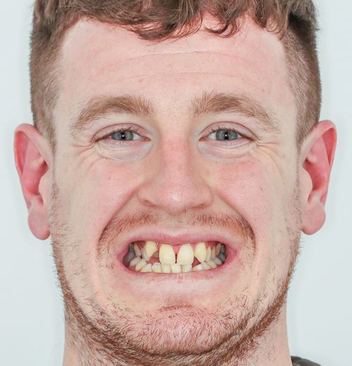 Orthodontics before - Graham Stagg